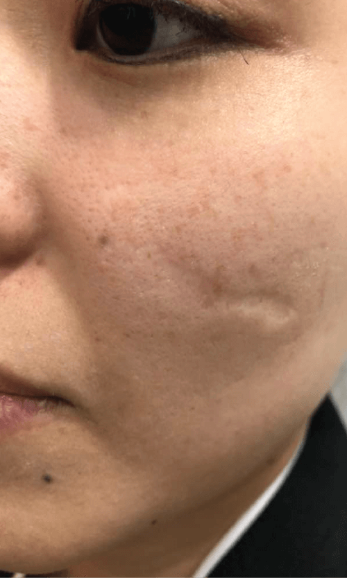 acne scars removal treatment