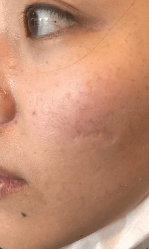 acne scars removal treatment