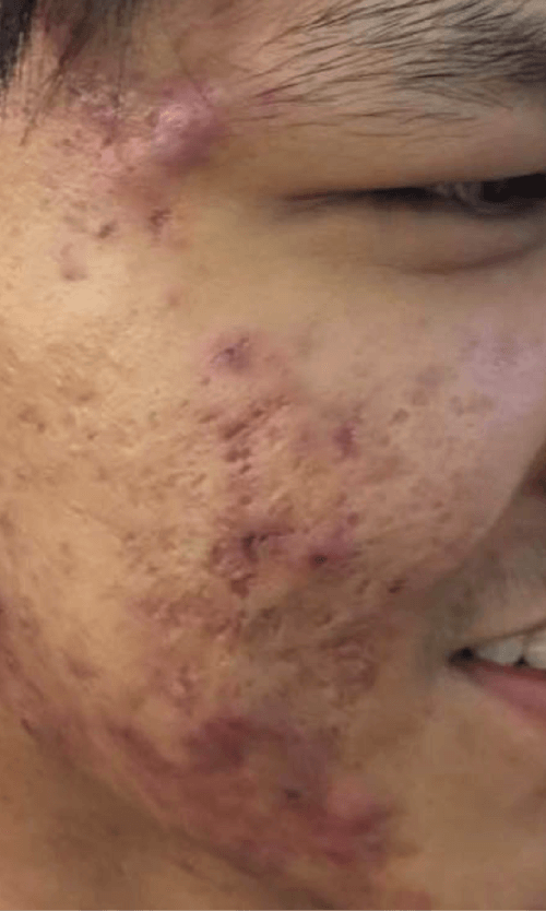 acne scars removal treatment