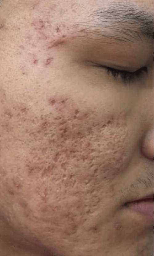 acne scars removal treatment