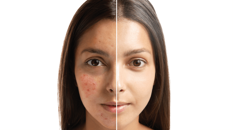 acne scars removal treatment