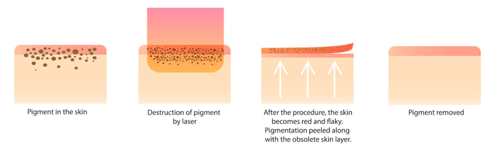 Laser Pigmentation Removal | Melasma Laser Treatment | One Doc