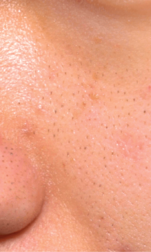 large pores treatment