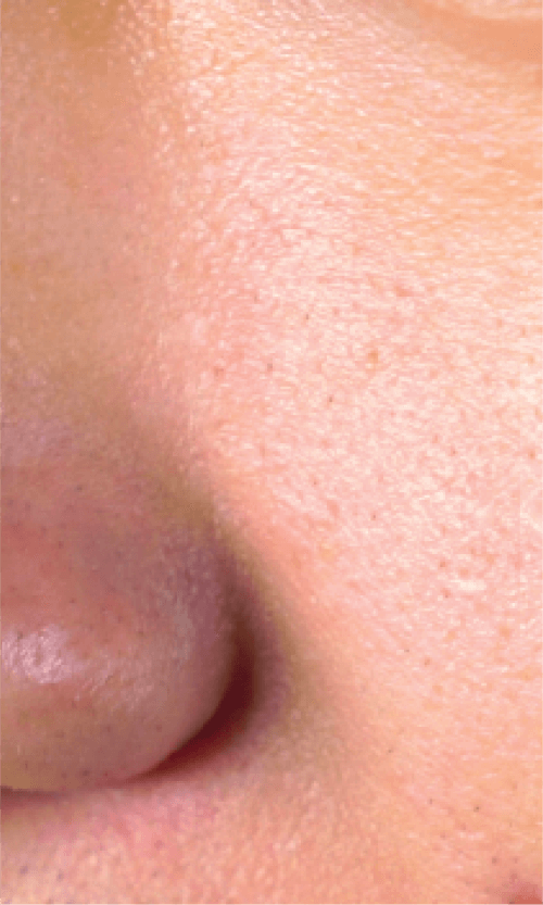 large pores treatment