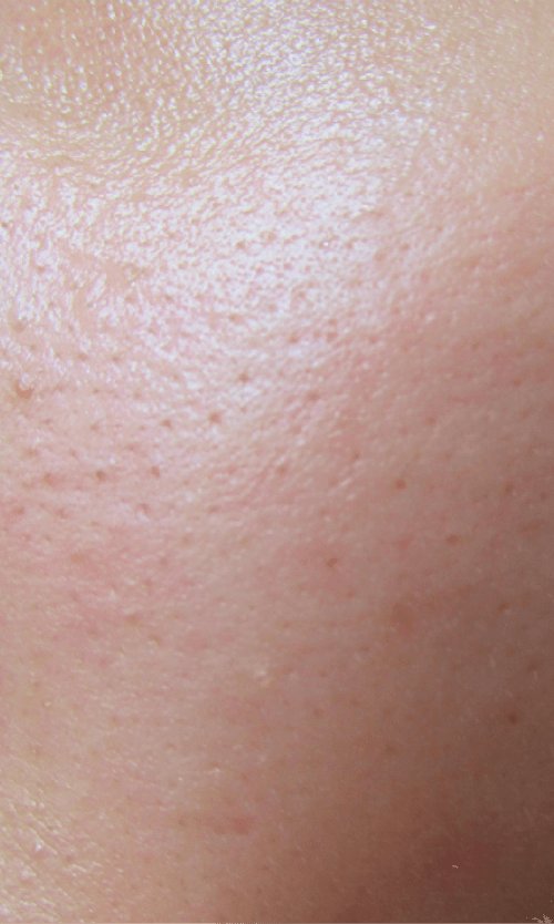 laser pore treatment