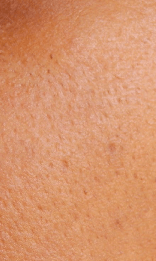 laser enlarged pores treatment
